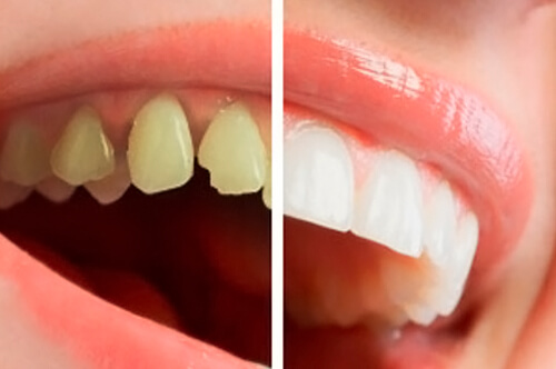 Odontologia Restauradora (Estética)