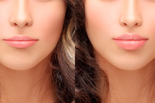 Preenchimento Labial